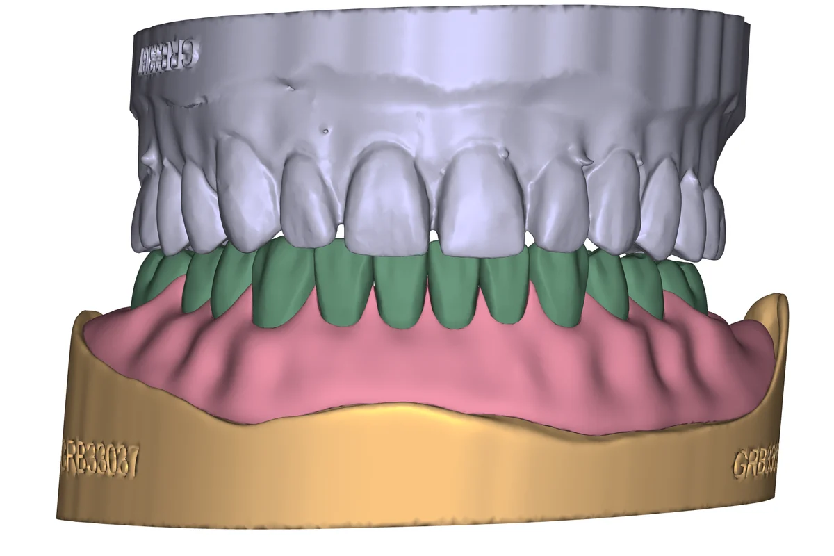 Denture finish example 1