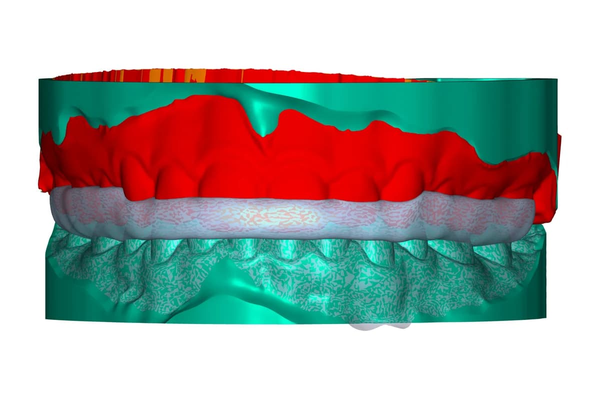 Occlusal splint example 1
