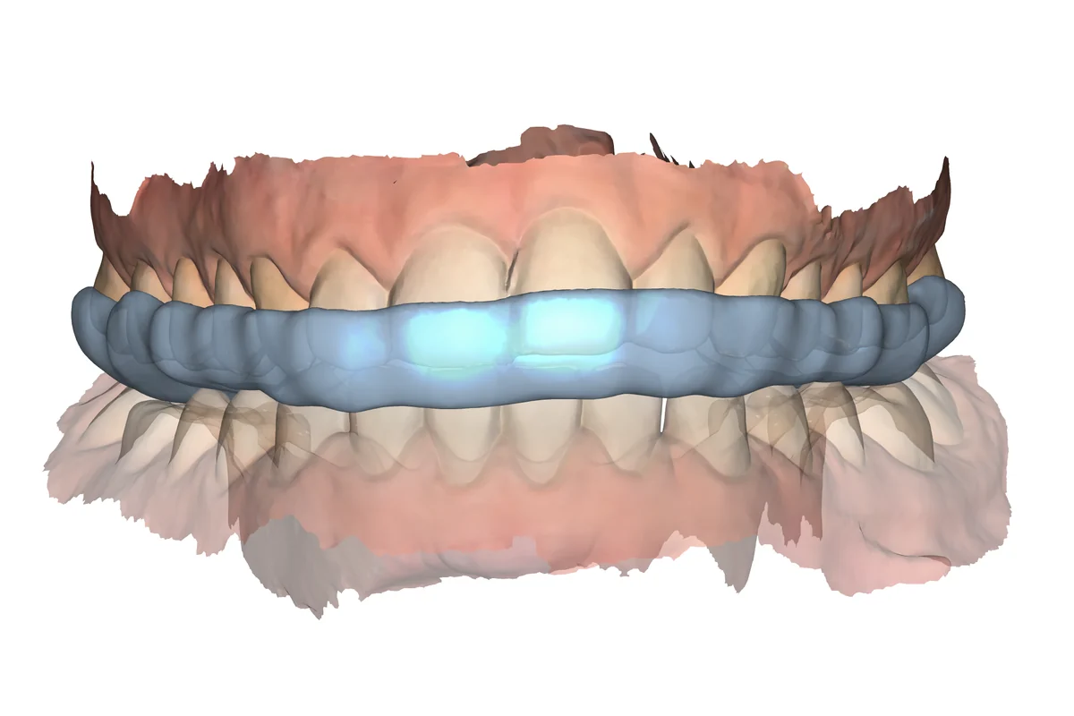 Splint QA example 1