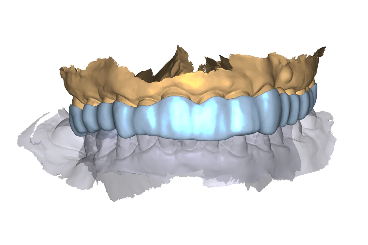 Occlusal splint example 1