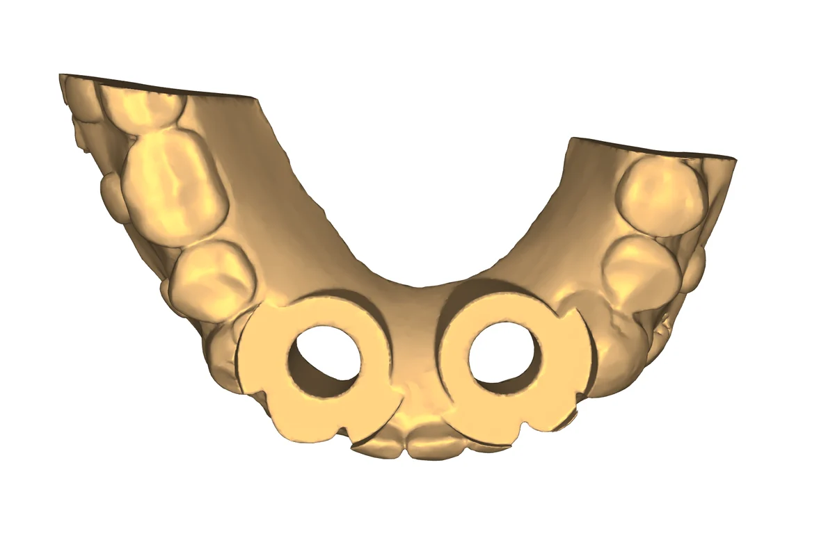 Endodontic guide example 1